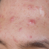 Anti acne arckezelő szett