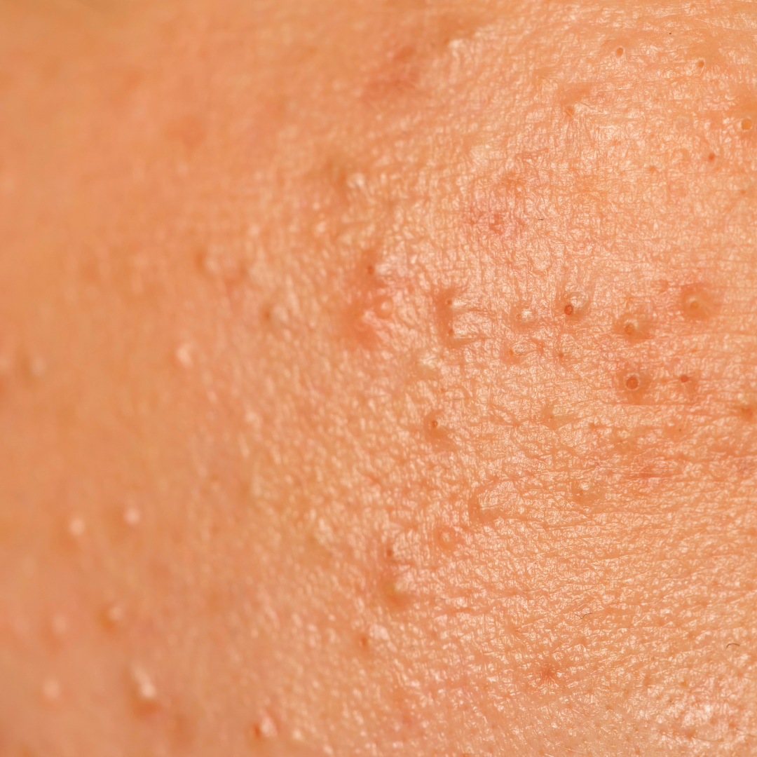 Anti-Acne line ajándékcsomag