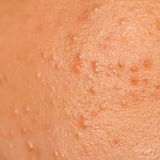 Anti-Acne line ajándékcsomag