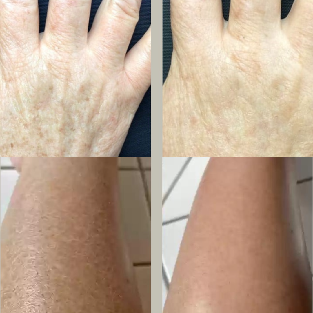 TRANEXAMIC+VITA C Testápoló